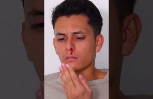 Stop a Nosebleed Fast with This Simple Hack!