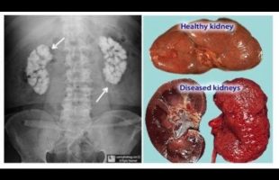 5 Silent Yet DEADLY Signs Your Kidneys Are FAILING