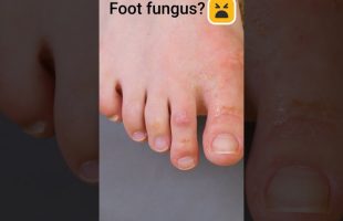 Get rid of foot fungus using this natural remedy #shorts