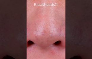 Goodbye, pesky backheads! This DIY Blackhead mask will get rid of them all! #shorts