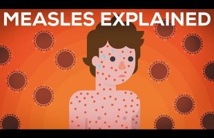 Measles Explained — Vaccinate or Not?
