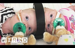 Surgeons Break Down Separating Conjoined Twins | WIRED